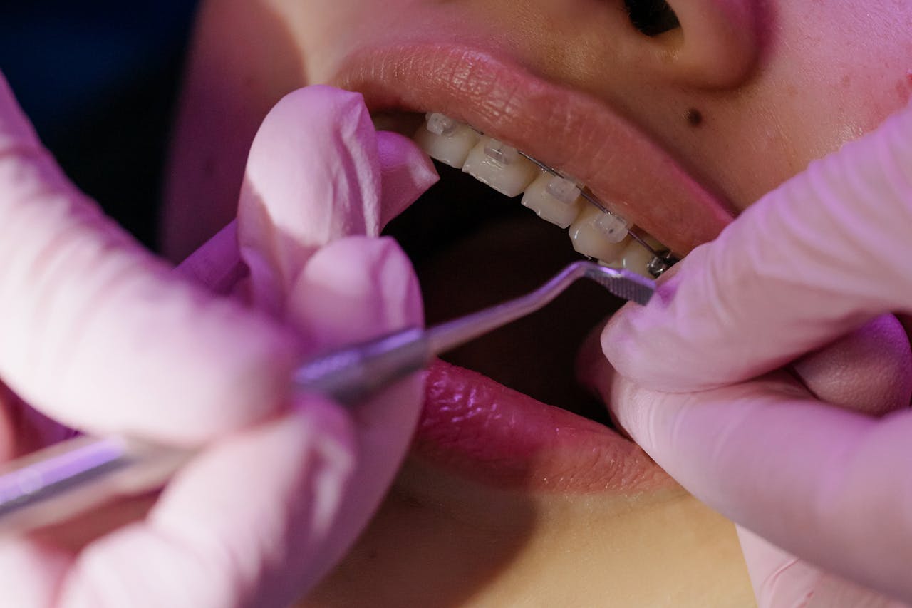 Dentista usando luvas cor-de-rosa faz ajuste em aparelho ortodôntico fixo nos dentes superiores de um paciente.